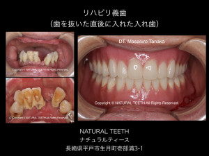 リハビリ義歯（入れ歯）抜歯即時義歯