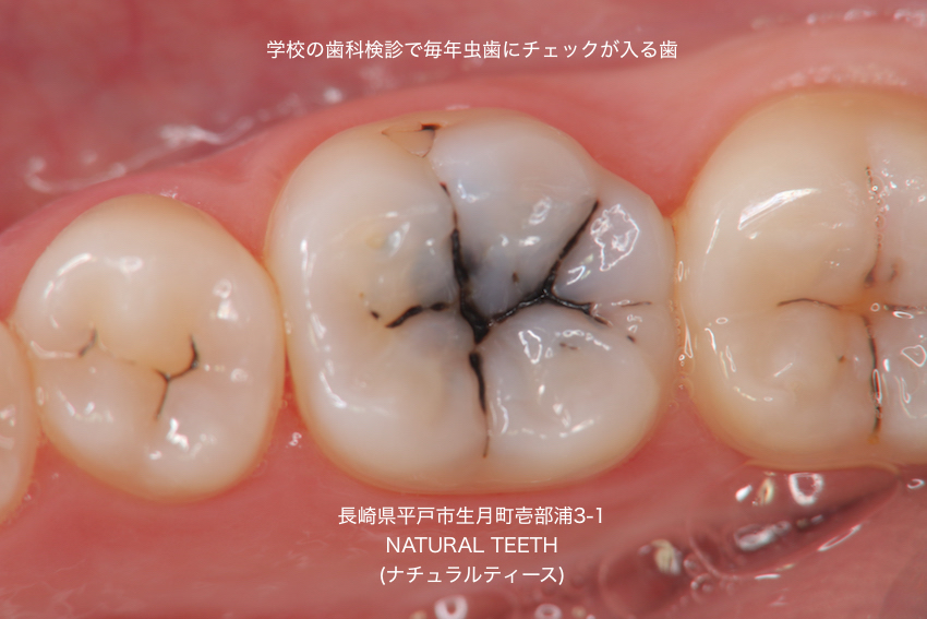 歯科検診 虫歯 予防 要観察歯 C