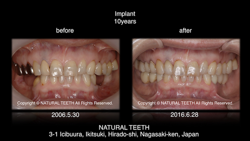 Implant 10years インプラント 10年 長崎 マイクロスコープ 歯医者