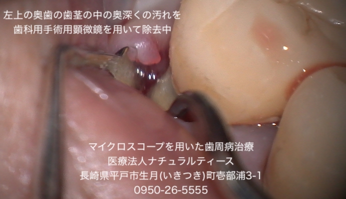 長崎 歯周病 予防 佐世保 平戸 マイクロスコープ 手術用顕微鏡 歯科衛生士