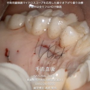 Instagrm 歯ぐき下がり蘇り治療.007