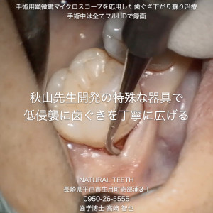 Instagrm 歯ぐき下がり蘇り治療.004