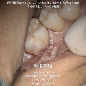 Instagrm 歯ぐき下がり蘇り治療.008