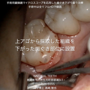 Instagrm 歯ぐき下がり蘇り治療.006