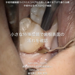 Instagrm 歯ぐき下がり蘇り治療.002